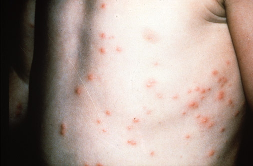 Pseudomonas: folliculitis