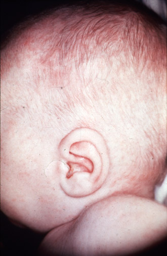 roseola rash picture