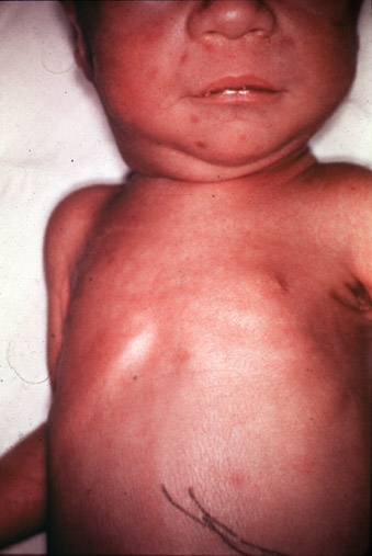 Rubella Syndrome