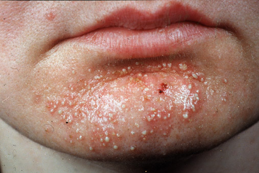 http://www.dermweb.com/skininfectionsandinfestations/graphics/jpegs/saureus3.jpg