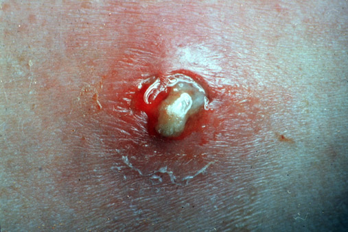 Staphylococcal Infections: MedlinePlus