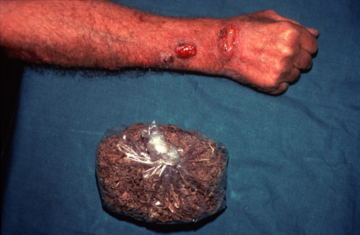 Sporotrichosis