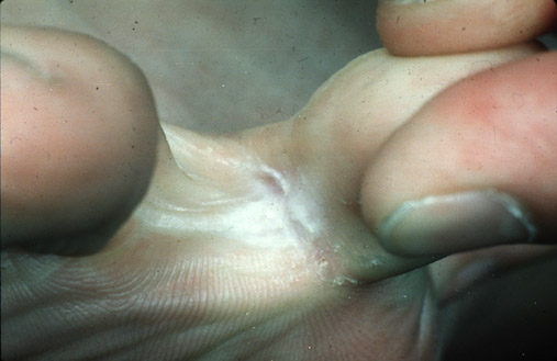 Tinea pedis