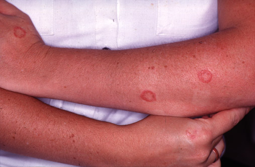 Tinea corporis induced by Microsporum canis