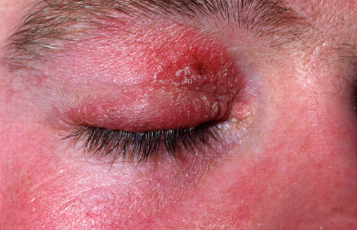 Dermatophyte infections - World Health Organization