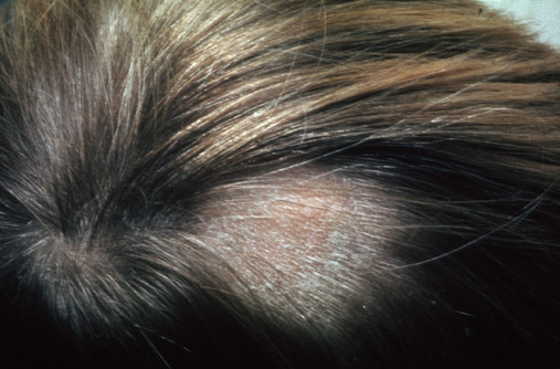 Tinea capitis