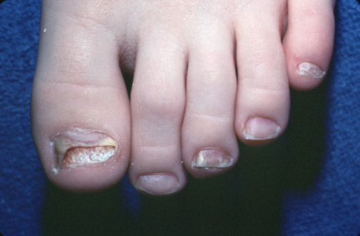 Onychomycosis: Pathogenesis, Diagnosis, and Management