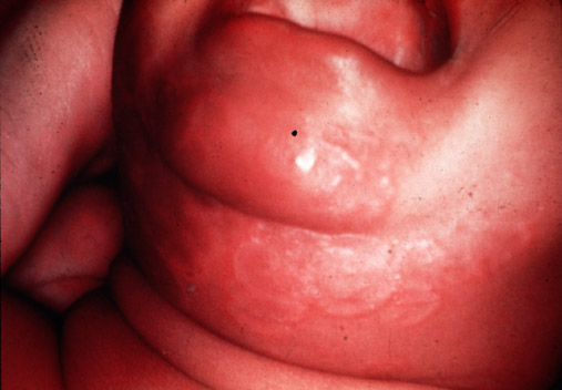 Congenital Syphilis: circinate rash