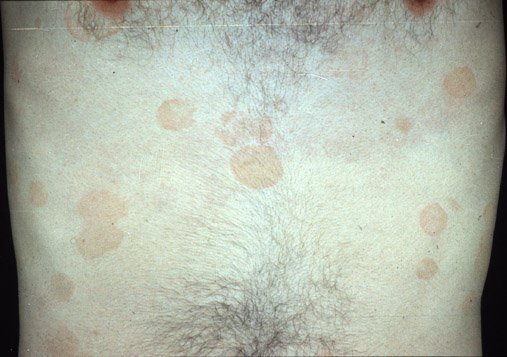 Tinea versicolor