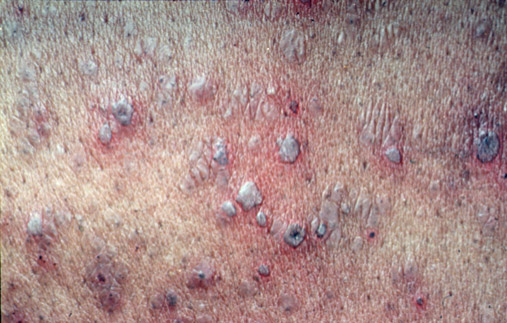 Varicella