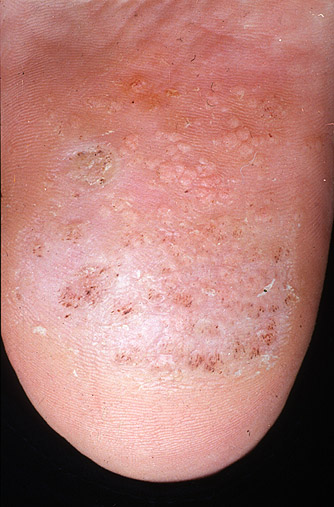 warts on skin #11