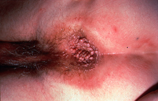 STD Facts - Human papillomavirus (HPV)