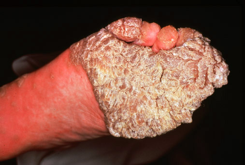 Warts in HIV patient