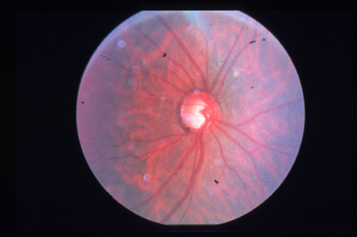 Glaucoma from Topical Steroid