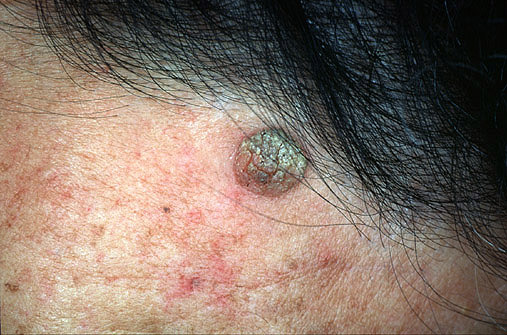 Seborrheic Keratosis: Risks, Diagnosis, & Treatment