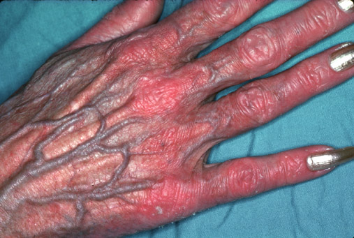 Steroid Side Effect: Steroid Atrophy